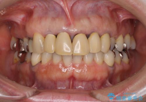 汚れてしまった保険のクラウン 前歯のオールセラミックの治療前