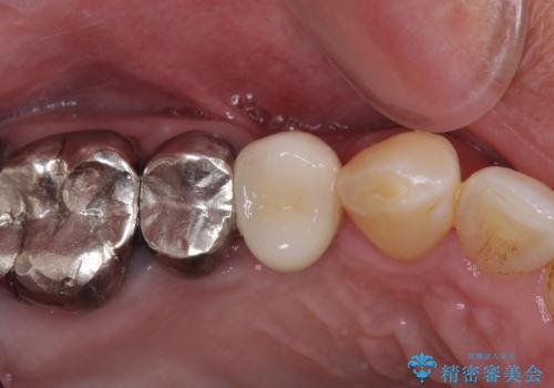 折れてしまった奥歯 インプラントによる補綴治療の治療後
