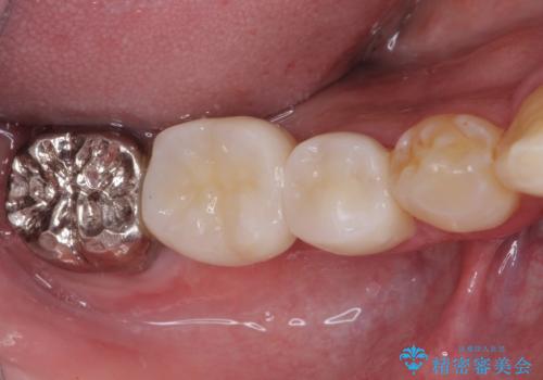 折れてしまった奥歯 インプラントによる補綴治療の治療後