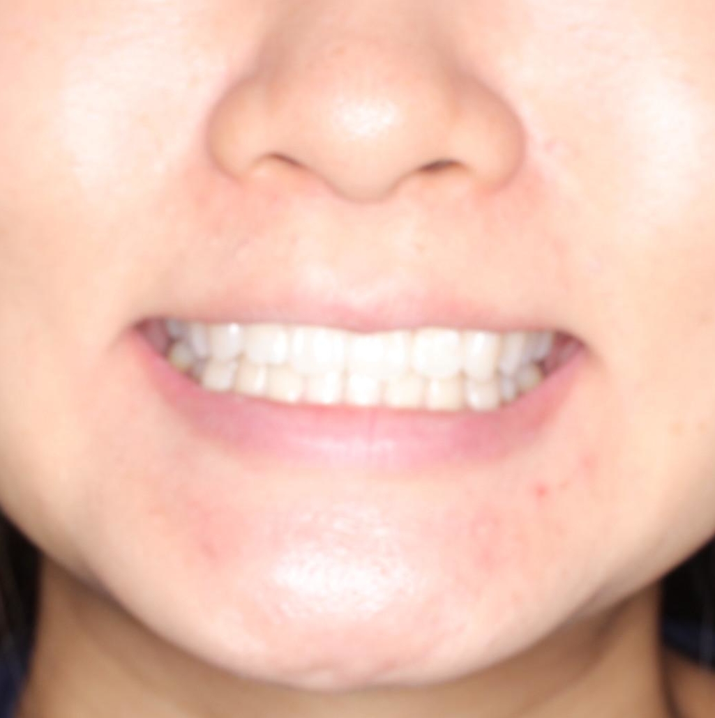 前歯の突出、深い噛み合わせ、ガタつきをマウスピース矯正(インビザライン)で治療した症例の治療後（顔貌）