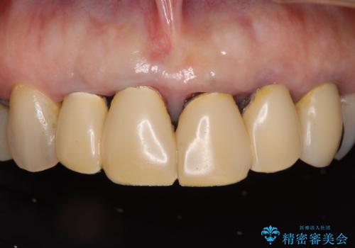 汚れてしまった保険のクラウン 前歯のオールセラミック