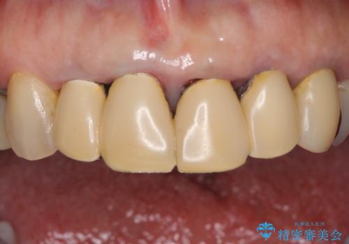 汚れてしまった保険のクラウン 前歯のオールセラミックの治療前