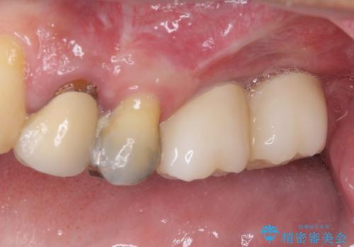 折れてしまった奥歯 インプラントによる補綴治療の治療後