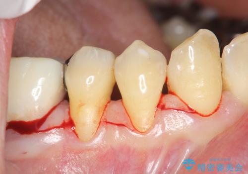 徐々に下がってきた歯肉へ再生療法(歯冠側移動術と結合組織移植術の併用)を施術し、丈夫な歯肉を獲得させた症例の治療前