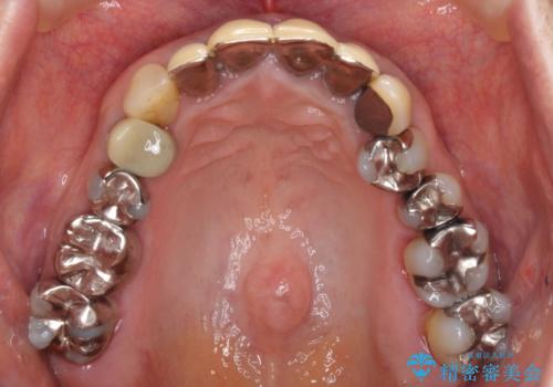 汚れてしまった保険のクラウン 前歯のオールセラミックの治療前