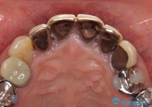 汚れてしまった保険のクラウン 前歯のオールセラミックの治療前