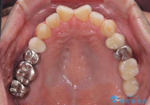 折れてしまった奥歯 インプラントによる補綴治療の治療後