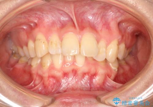 前歯の突出、深い噛み合わせ、ガタつきをマウスピース矯正(インビザライン)で治療した症例の治療前