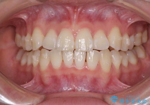 海外留学をしながら歯並びを整えたい インビザラインによる矯正治療の治療中