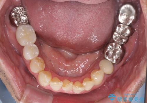 折れてしまった奥歯 インプラントによる補綴治療の治療後