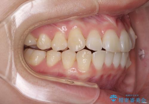 海外留学をしながら歯並びを整えたい インビザラインによる矯正治療の治療中