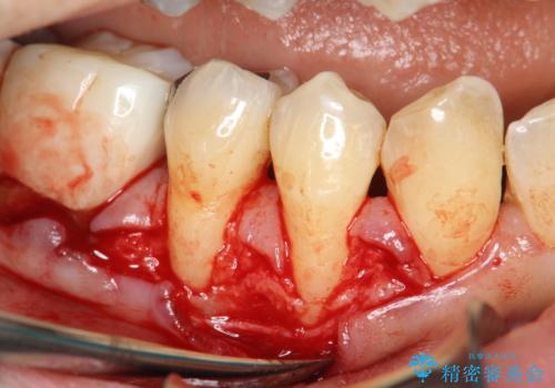 徐々に下がってきた歯肉へ再生療法(歯冠側移動術と結合組織移植術の併用)を施術し、丈夫な歯肉を獲得させた症例の治療中