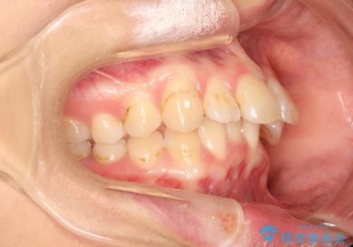 前歯の突出、深い噛み合わせ、ガタつきをマウスピース矯正(インビザライン)で治療した症例の治療前