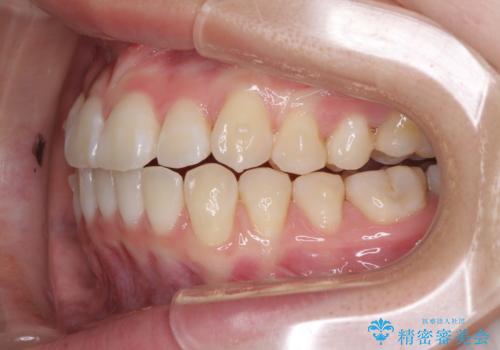 海外留学をしながら歯並びを整えたい インビザラインによる矯正治療の治療中