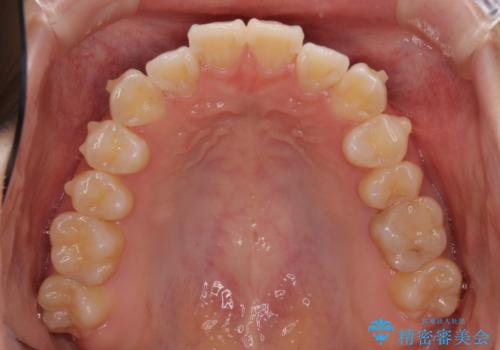 海外留学をしながら歯並びを整えたい インビザラインによる矯正治療の治療中