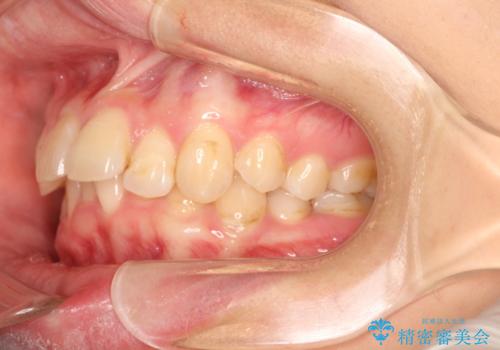 前歯の突出、深い噛み合わせ、ガタつきをマウスピース矯正(インビザライン)で治療した症例の治療前