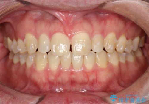 前歯の真ん中の隙間を閉じたい インビザラインによる目立たない矯正の治療中