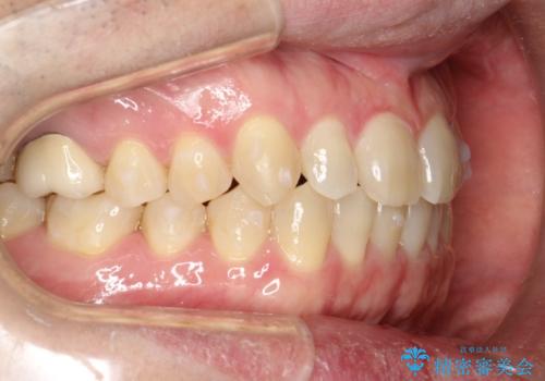 前歯の真ん中の隙間を閉じたい インビザラインによる目立たない矯正の治療中