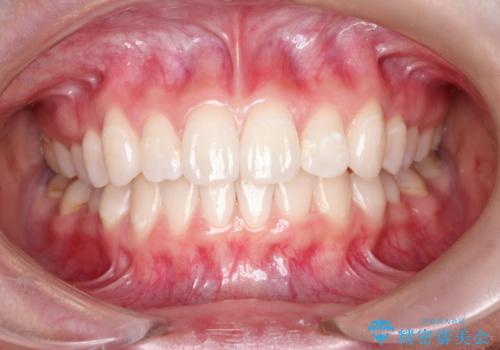 前歯の突出、深い噛み合わせ、ガタつきをマウスピース矯正(インビザライン)で治療した症例の治療後