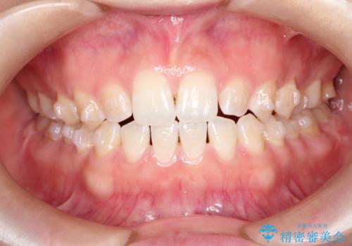 前歯の隙間を閉じたい インビザラインによる矯正の治療中
