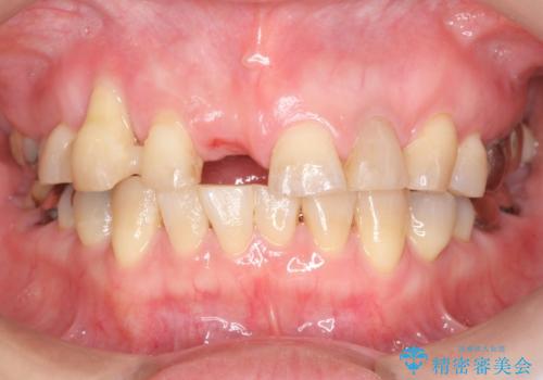 過度な咬合力 歯ぎしりで抜けた歯の欠損補綴の症例 治療前