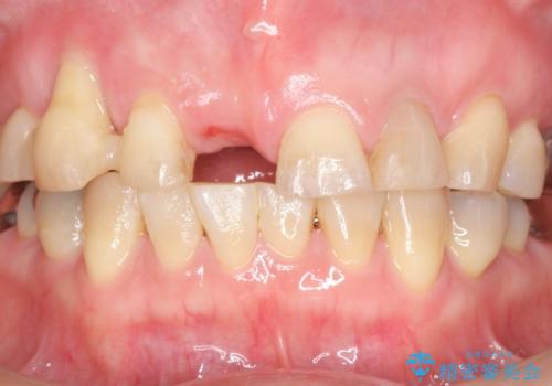 過度な咬合力　歯ぎしりで抜けた歯の欠損補綴の治療前