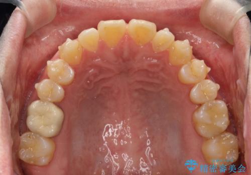 前歯の真ん中の隙間を閉じたい　インビザラインによる目立たない矯正の治療中