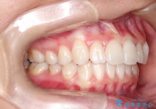 前歯の突出、深い噛み合わせ、ガタつきをマウスピース矯正(インビザライン)で治療した症例の治療後