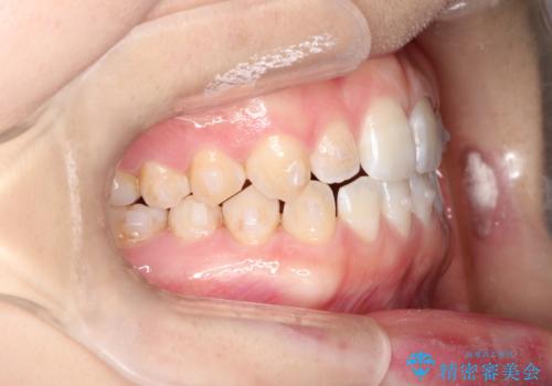前歯の隙間を閉じたい インビザラインによる矯正の治療中
