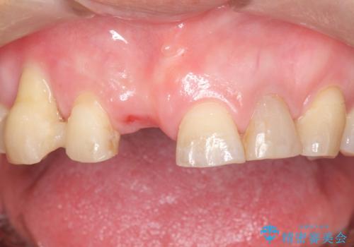 過度な咬合力 歯ぎしりで抜けた歯の欠損補綴の治療前
