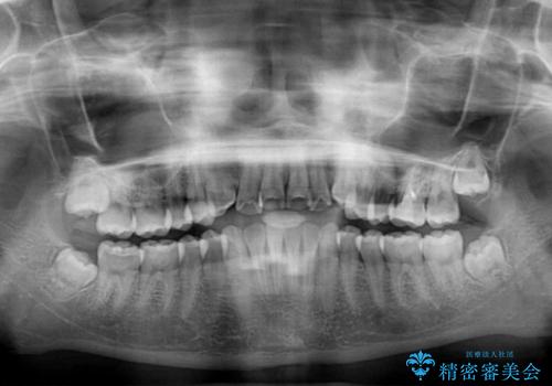 海外留学をしながら歯並びを整えたい インビザラインによる矯正治療の治療前