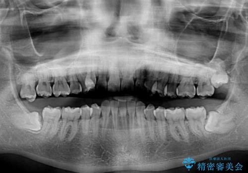 気になる八重歯を治したい インビザラインと補助装置を用いた抜歯治療の治療前