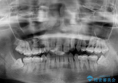 抜歯矯正の後戻りによるすきっ歯をインビザラインでの治療前
