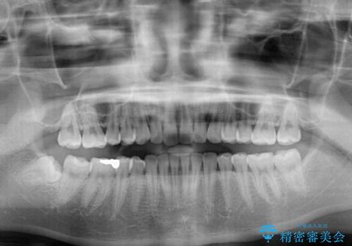 気になる前歯を治したい インビザライン矯正とオールセラミッククラウンの治療前