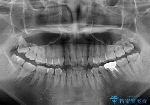 前歯のデコボコを治したい ワイヤー矯正の治療前