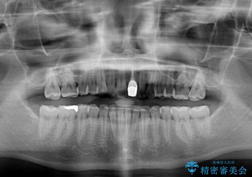 気になる前歯を治したい インビザライン矯正とオールセラミッククラウンの治療後