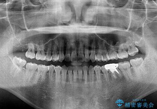 前歯のデコボコを治したい ワイヤー矯正の治療後