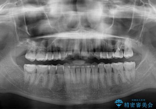 海外留学をしながら歯並びを整えたい インビザラインによる矯正治療の治療後