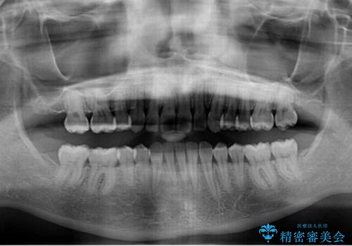 気になる八重歯を治したい　インビザラインと補助装置を用いた抜歯治療の治療後