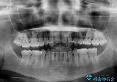 抜歯矯正の後戻りによるすきっ歯をインビザラインでの治療後