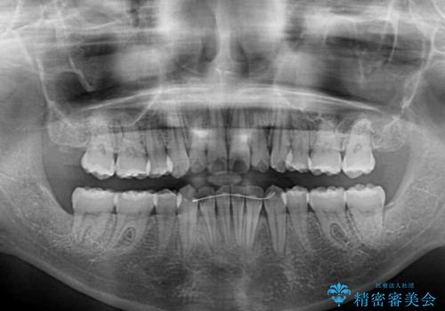 【モニター】 インビザラインによる後戻りの再矯正治療の治療後