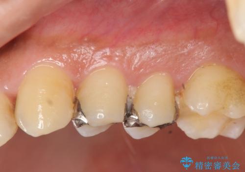 近所で入れた銀歯に食べ物が挟まるの症例 治療前