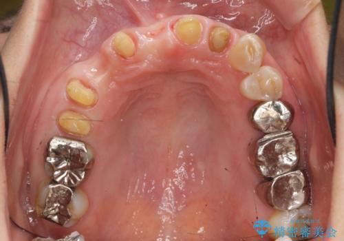 過度な咬合力 歯ぎしりで抜けた歯の欠損補綴の治療中