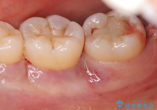 歯周病　再生治療で歯を残すの治療前