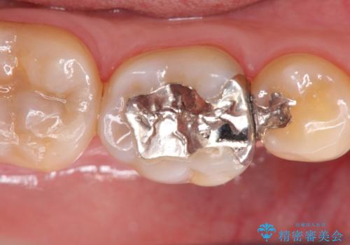 歯の神経を残す、丁寧な虫歯の除去の症例 治療前