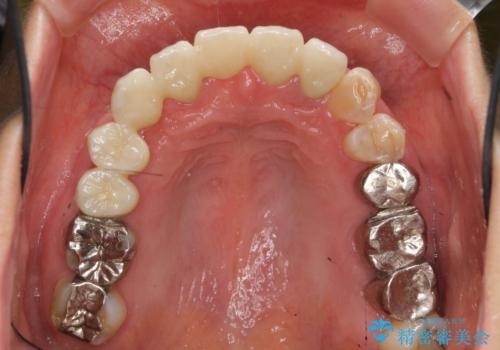 過度な咬合力 歯ぎしりで抜けた歯の欠損補綴の治療後