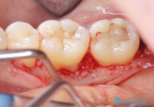 歯周病 再生治療で歯を残すの治療中