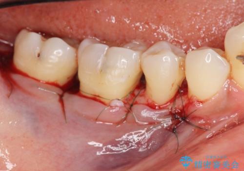 歯周病　再生治療で歯を残すの治療後