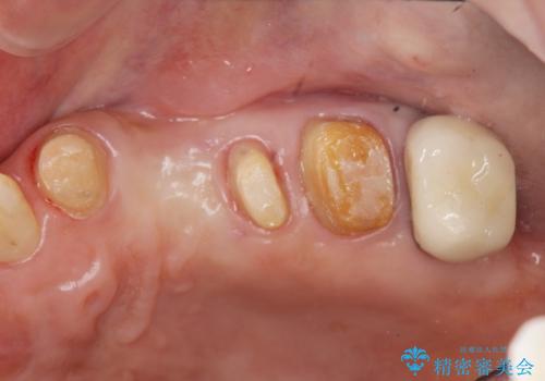 歯周病 側方力に対抗するブリッジ補綴の治療中