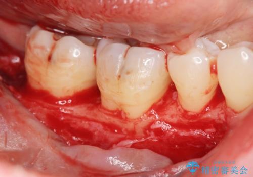 歯周病 再生治療で歯を残すの治療後